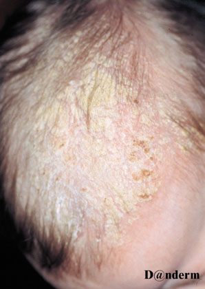 A Baby With An Infantile Variant Of Seborrhoeic Dermatitis Of