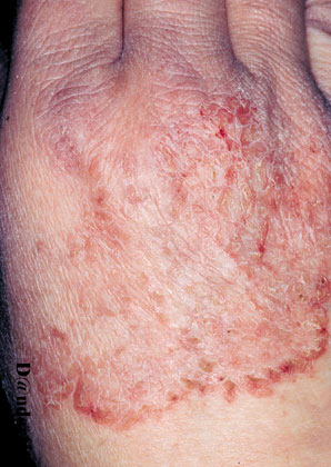 2-37 Irritant hand eczema mimicking dermatophytosis (2 of 2)