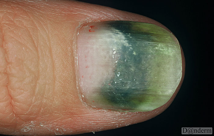 Nail Infection With Pseudomonas Aeruginose
