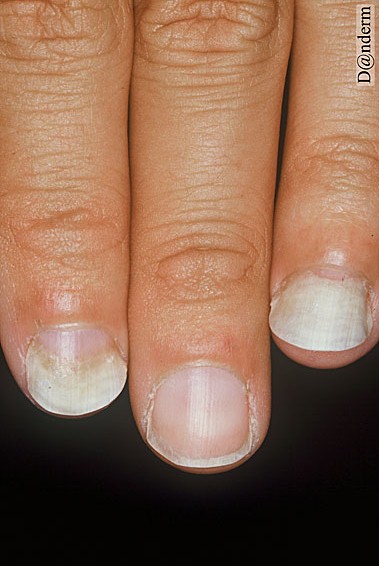 5-40-4 Psoriasis of the nails